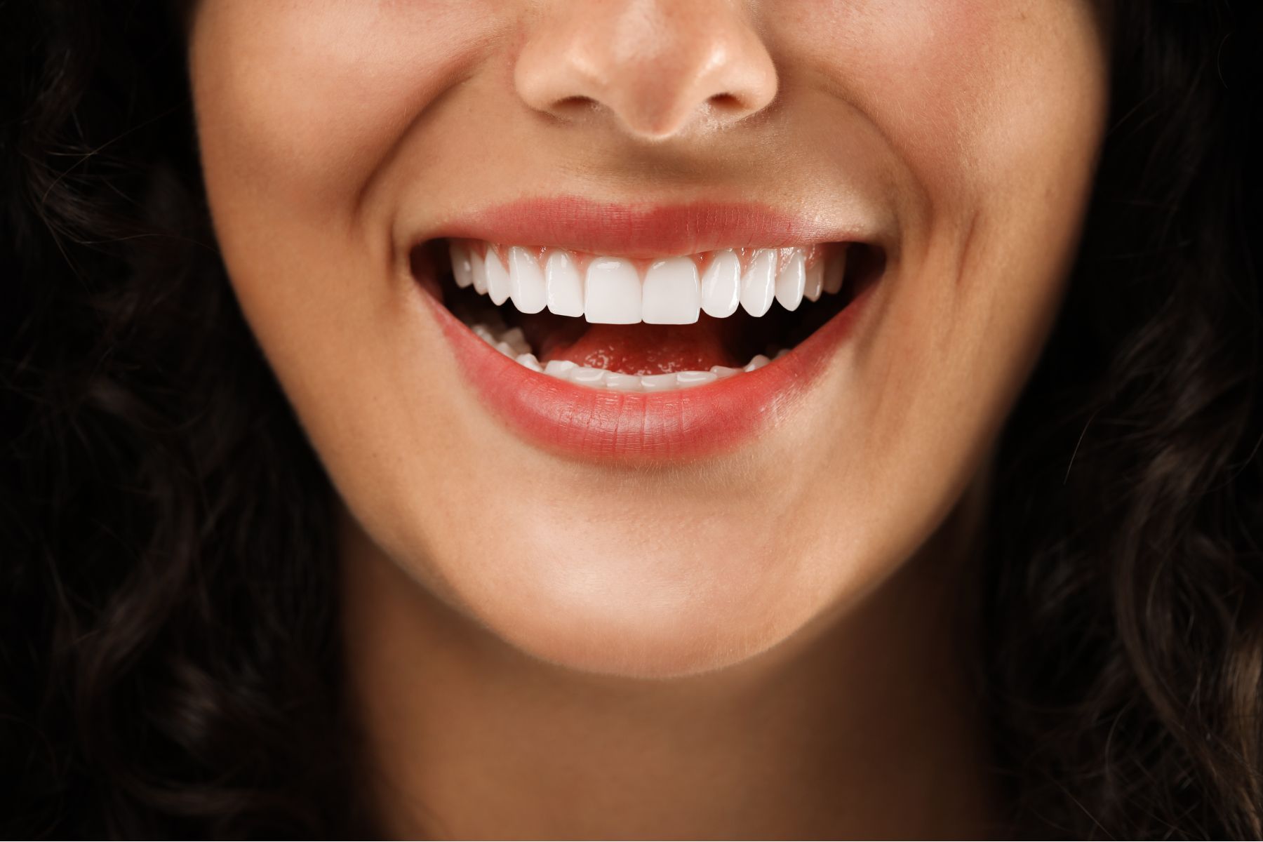 Hollywood Smile makeover result with veneers and whitening performed at Smile Center Turkey