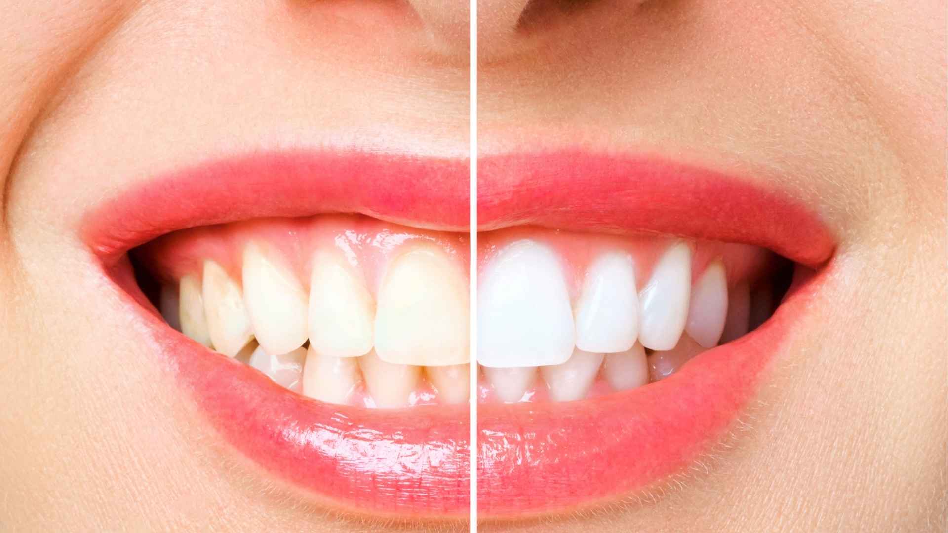 Before and after teeth whitening showing visible improvement in tooth color and smile aesthetics